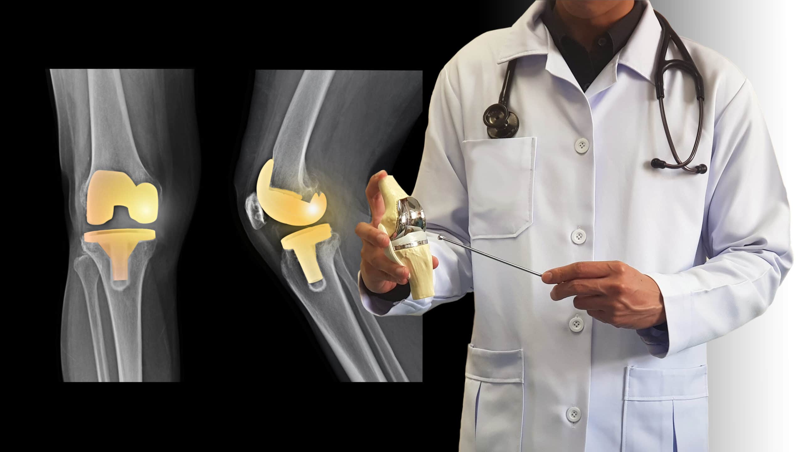 a surgeon holding a model of a knee showing arthroplasty, with an x-ray of knee replacement surgery.