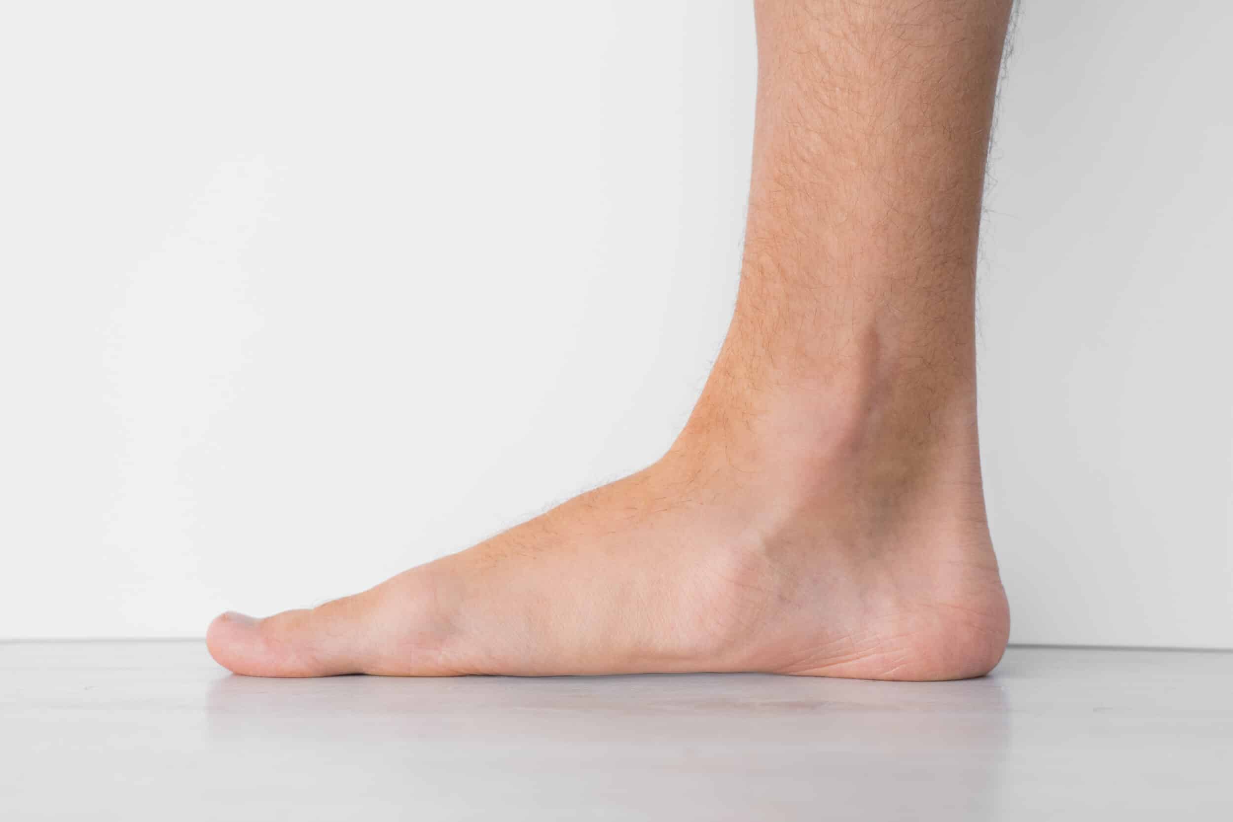 A close-up side view of flat feet with a bare foot showing a flat arch, standing on a smooth surface against a plain background.