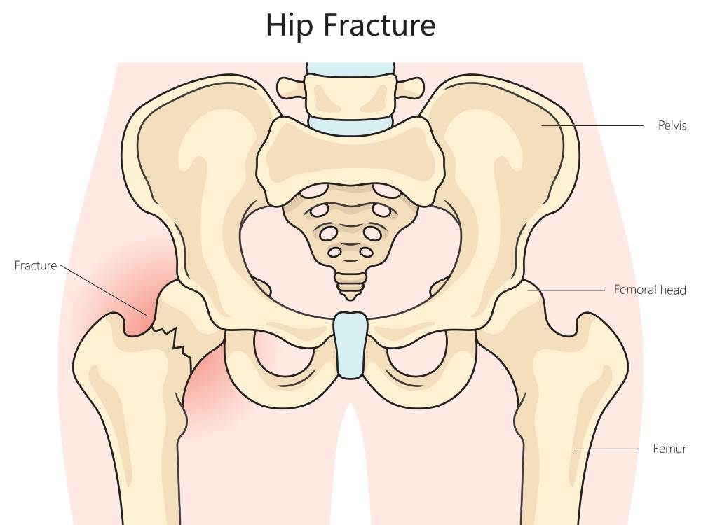 Illustrated diagram depicts a hip fracture, also shows the femur and pelvis in relation to the hip.