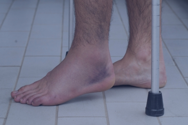 Treatment for Fractures and Sprains A foot sprain with bruising on outside of foot